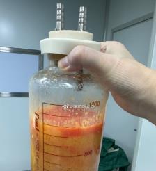 老河口水动力吸脂手术要做多久？